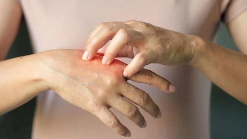 Baharda sık görülen 5 cilt hastalığı
