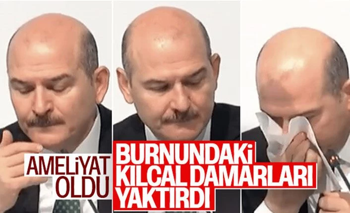 Süleyman Soylu'nun burnundaki kılcal damarlar yakıldı