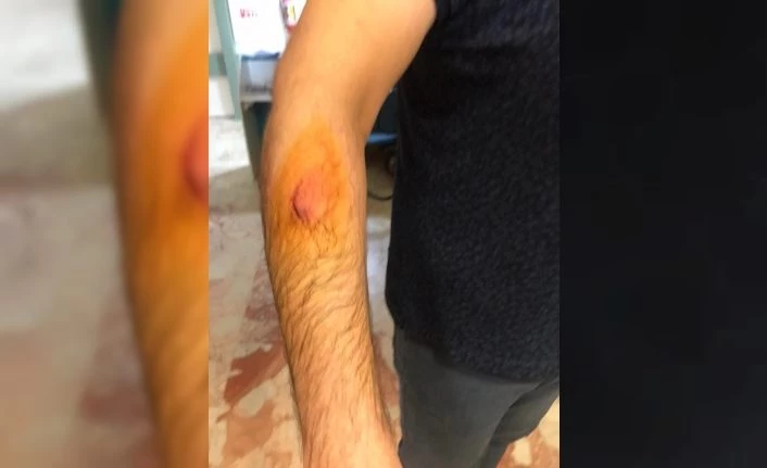 Hasta yakını, sağlık çalışanını ısırıp, darp etti